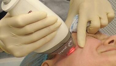 Kā tiek veikta frakcionēta ādas atjaunošana