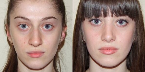 Meitene pirms un pēc plazmas sejas ādas atjaunošanas
