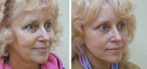 Sieviete pirms un pēc plazmas sejas ādas atjaunošanas